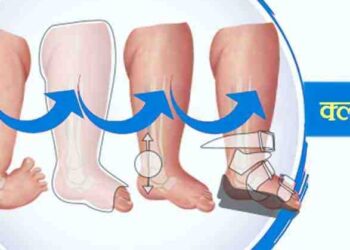 Establishment of Club Foot Clinic at Kamthe