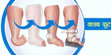 Establishment of Club Foot Clinic at Kamthe