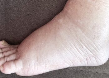 'Triple Drug Therapy' campaign to eradicate elephantiasis