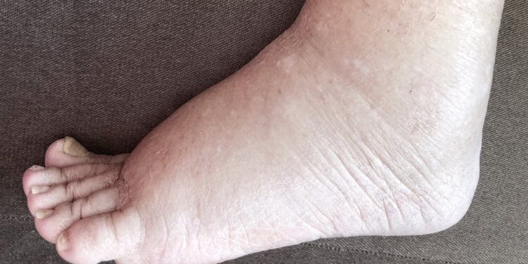 'Triple Drug Therapy' campaign to eradicate elephantiasis